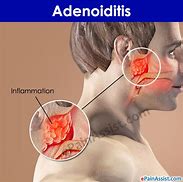Image result for adenoudes