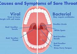 Image result for Bacterial Sore Throat