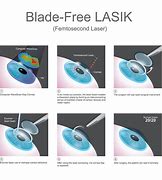 Image result for Lasik Procedure