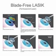 Image result for Lasik Treatment