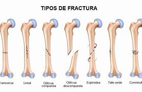 Image result for fractura