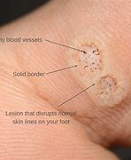 Image result for warts cause and treatment