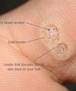 Image result for Infected Wart Bottom of Foot