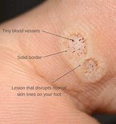 Image result for Seed Wart Foot