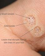 Image result for Plantar Warts On Feet with Seeds