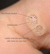 Image result for Pics of Plantar Warts On Feet
