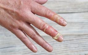 Image result for Finger Injured in a Robot Welder