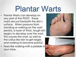 Image result for Plantar Wart