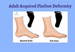 Image result for Acquired FlatFoot