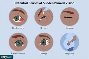 Image result for Sudden Blurry Vision