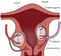 Image result for Images of Fibroids