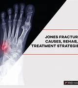 Image result for What Causes a Jones Fracture