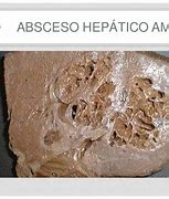 Image result for absceao