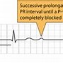 Image result for Mobitz Type 2 Heart Block Treatment