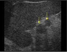 Image result for Accessory Spleen Ultrasound