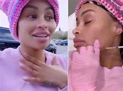 Image result for Blac Chyna dissolves facial fillers