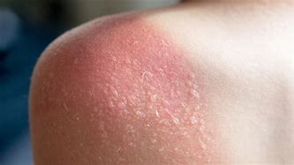 Image result for Sun Damage On Shoulders