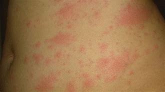 Image result for Covid 19 Skin Rashes