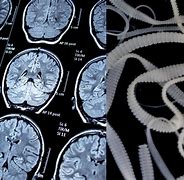 Image result for Brain Parasites in Humans