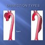 Image result for Aortic Dissection Symptoms