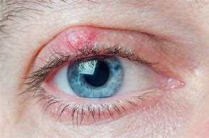 Image result for Eye Lump On Eyelid