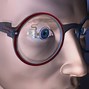 Image result for Retinal Implant