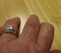 Image result for Cricket Insect Bite