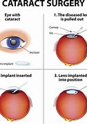 Image result for Post Cataract Surgery