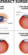 Image result for Cataract Vision Before and After