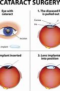 Image result for Cataract Surgery