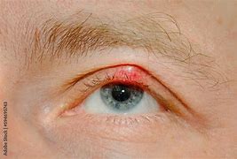 Image result for Folliculitis Eye