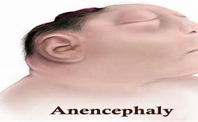 Image result for Anencephaly at 8Wk