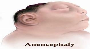 Image result for Anencephalus