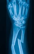 Image result for Broken Arm X-ray