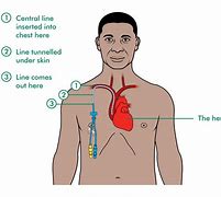Image result for PICC Line Types