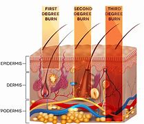 Image result for Third-Degree Skin Burn