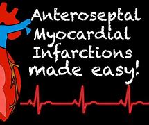 Image result for Anteroseptal Myocardial Infarction