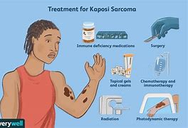 Image result for Kaposi's Sarcoma Treatment