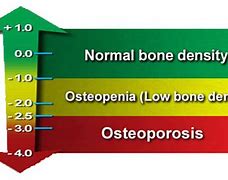 Image result for Bone Density Test Results Chart