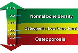 Image result for Bone Density Chart for Men