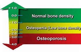 Image result for Bone Density Score Chart