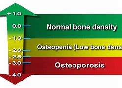 Image result for Bone Mineral Density Chart