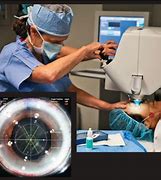 Image result for Refractive Surgery