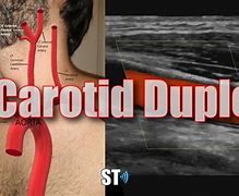 Image result for Carotid Doppler Ultrasound Anatomy