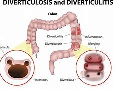 Image result for Diverticulitis