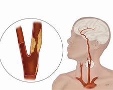 Image result for Carotid Artery Lump in Neck