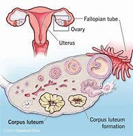 Image result for Corpus Luteum Cyst