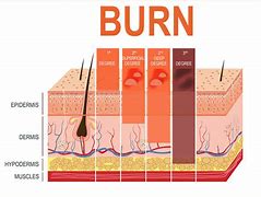 Image result for Skin Burn Diagram
