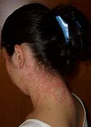 Image result for Itchy Moles On Skin