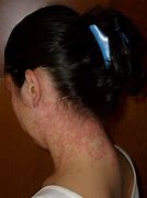 Image result for Identifying Skin Rashes Children